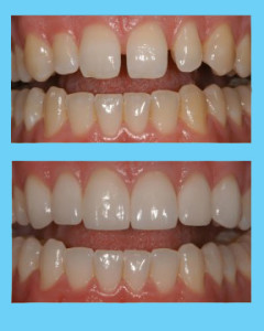 Veneers_example