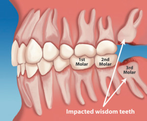 wisdom_teeth